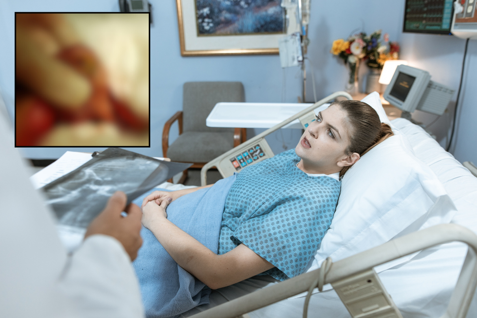 Woman has cyst removed and is horrified to learn it grew teeth, hair, and maybe even an eyeball