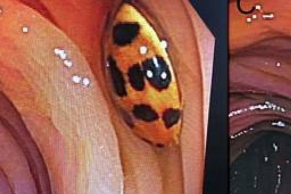 Doctors are surprised by unexpected stowaway during routine colonoscopy: a ladybug.