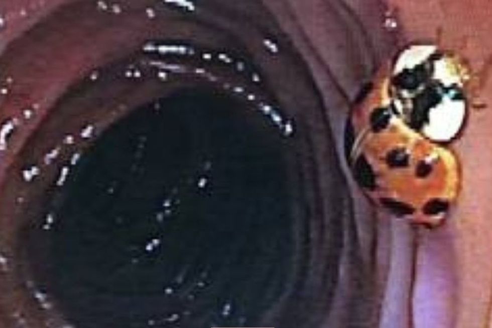 colonoscopy ladybug; ladybug; colonoscopy surprises; bug during colonoscopy; colonoscopy prep