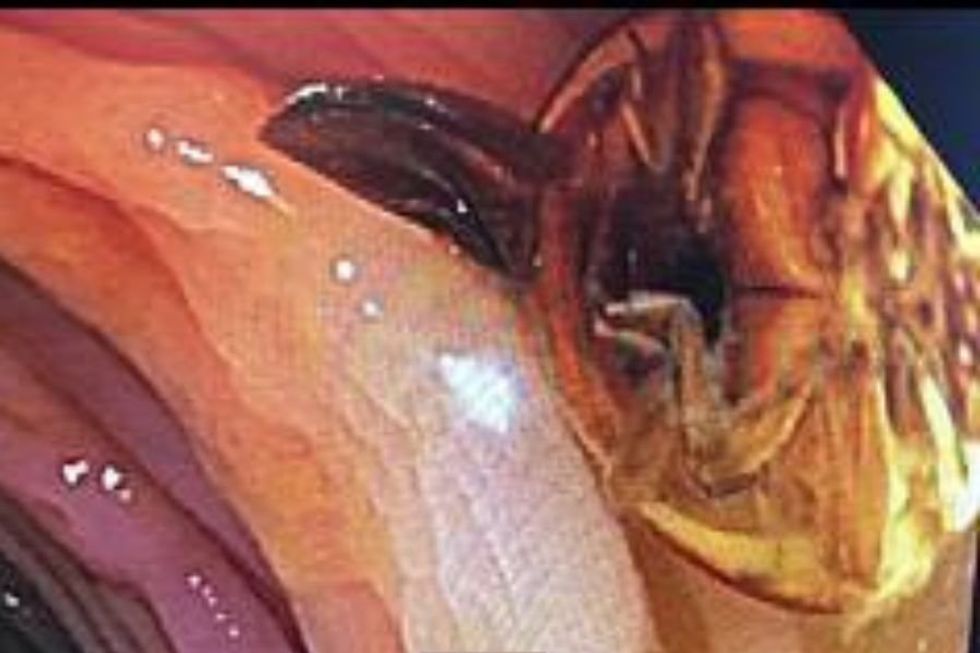 colonoscopy ladybug; ladybug; colonoscopy surprises; bug during colonoscopy; colonoscopy prep