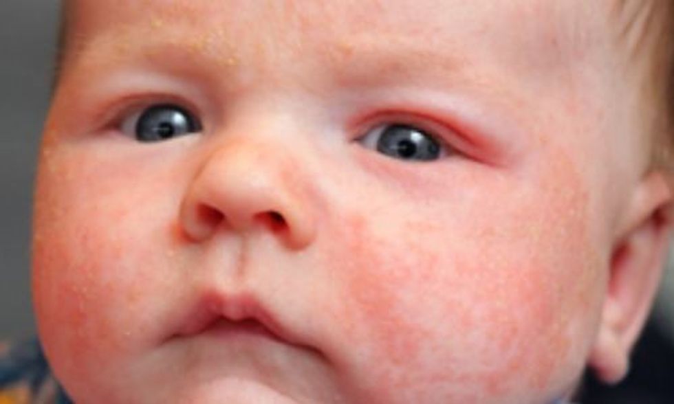 4 Natural Remedies for Treating Eczema