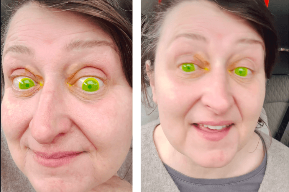 An Irish woman went to the doctor for a routine eye exam. She left with bright neon green eyes.