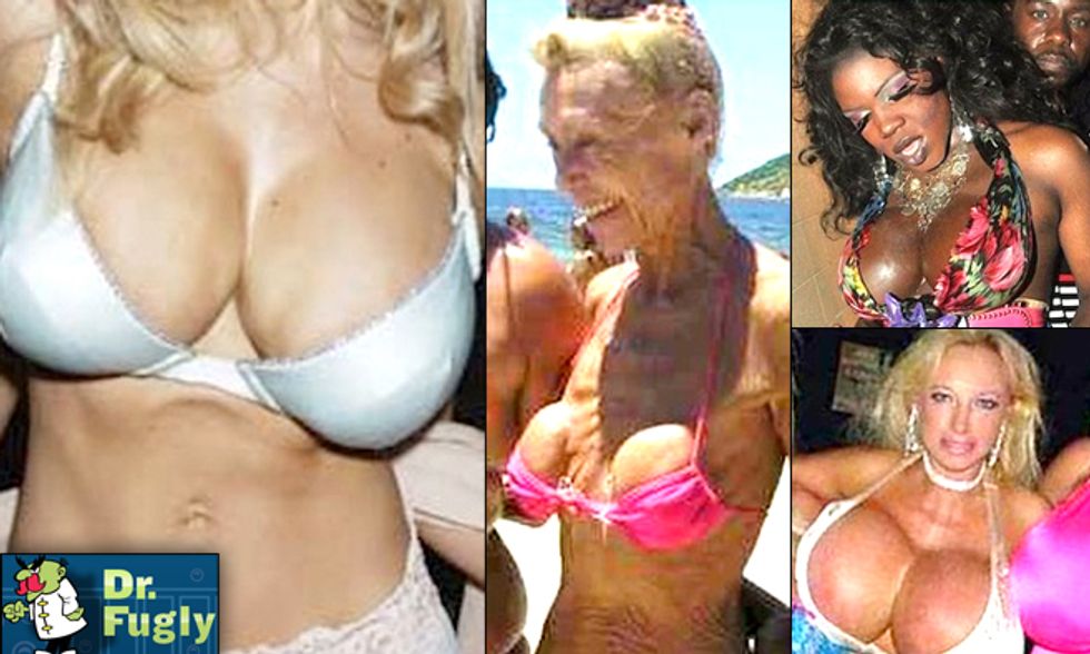 Boob Job Blunders—Big, Lopsided and Very, Very Botched Plastic Surgery