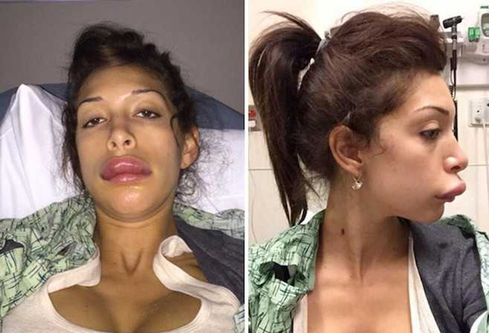 Farrah Abraham Suffers Truly Dreadful Lip Implant Disaster
