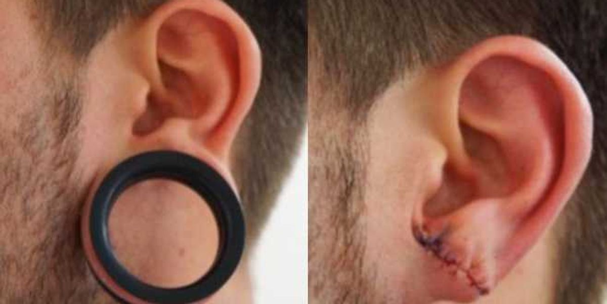 Plastic Surgery Fix For Those Gaping Ear Holes! Popdust