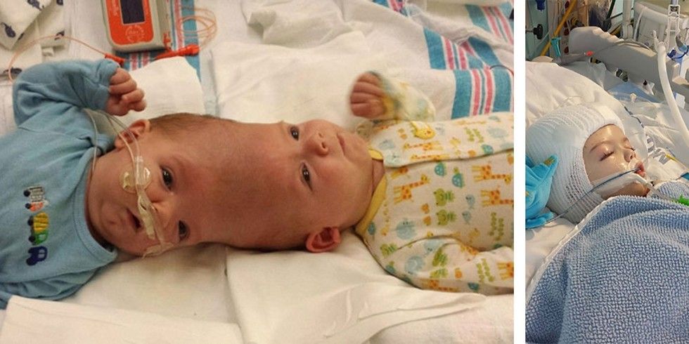 These Conjoined Twins Have Finally Been Separated After 16 Hours Of ...