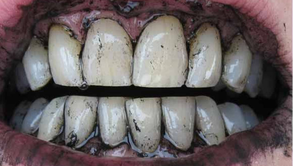 I Tried The Activated Charcoal Teeth Whitener And Here's What Happened