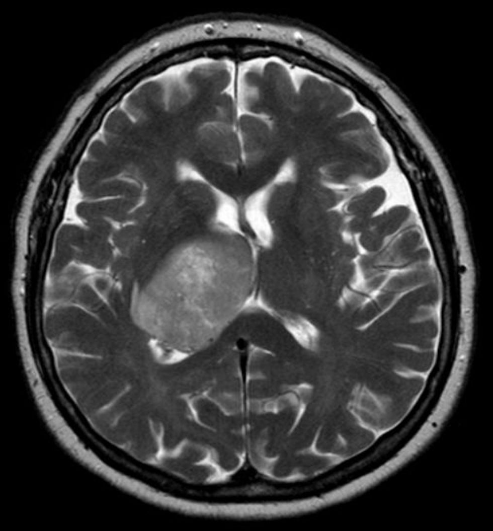 oncolytic-virotherapy-a-permanent-cure-for-cancer