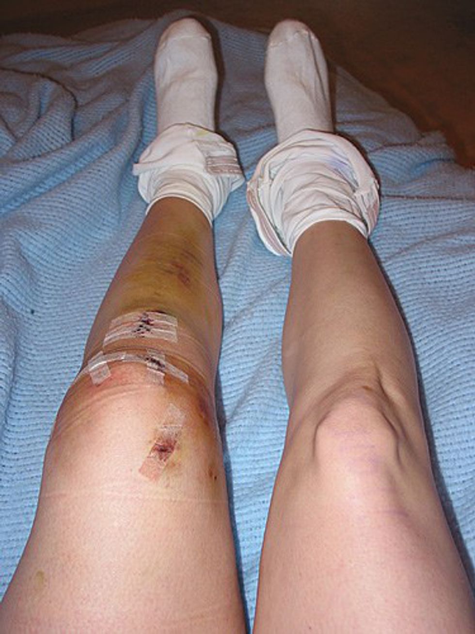 10 Things That Happen When You Tear Your ACL