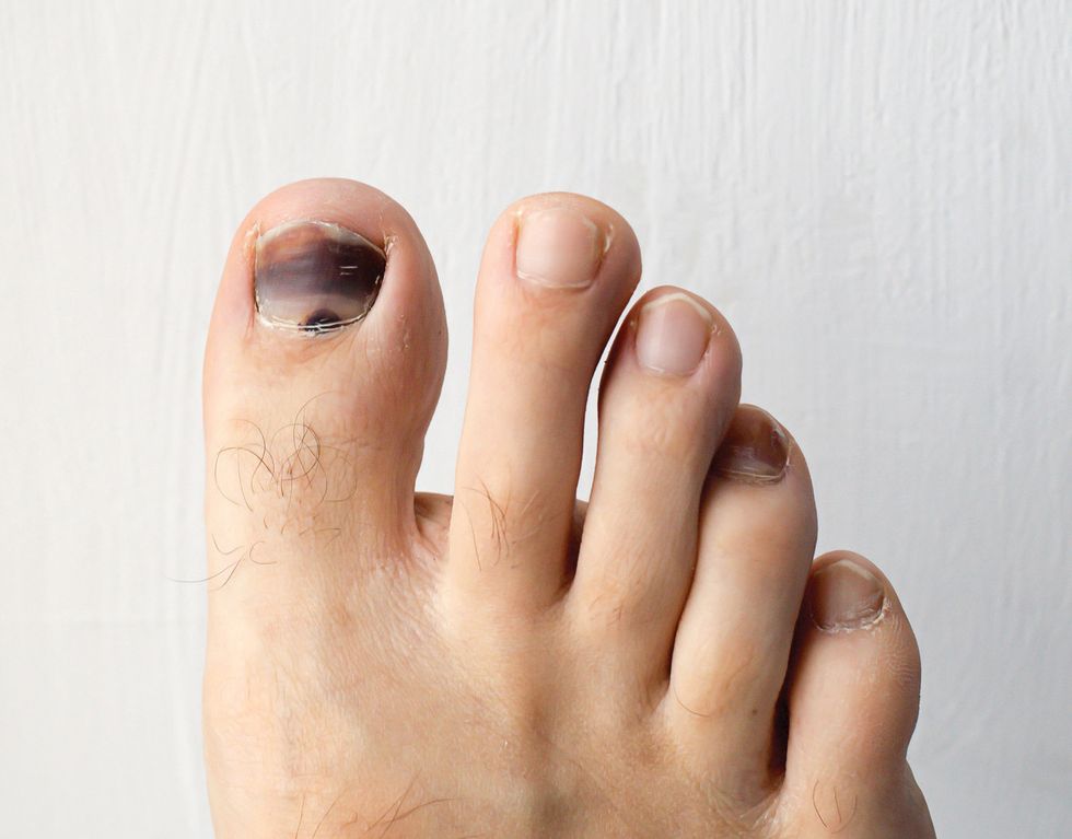 Toenail Issues - Dance Spirit