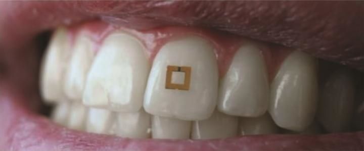This tooth sensor tracks what you eat and drink