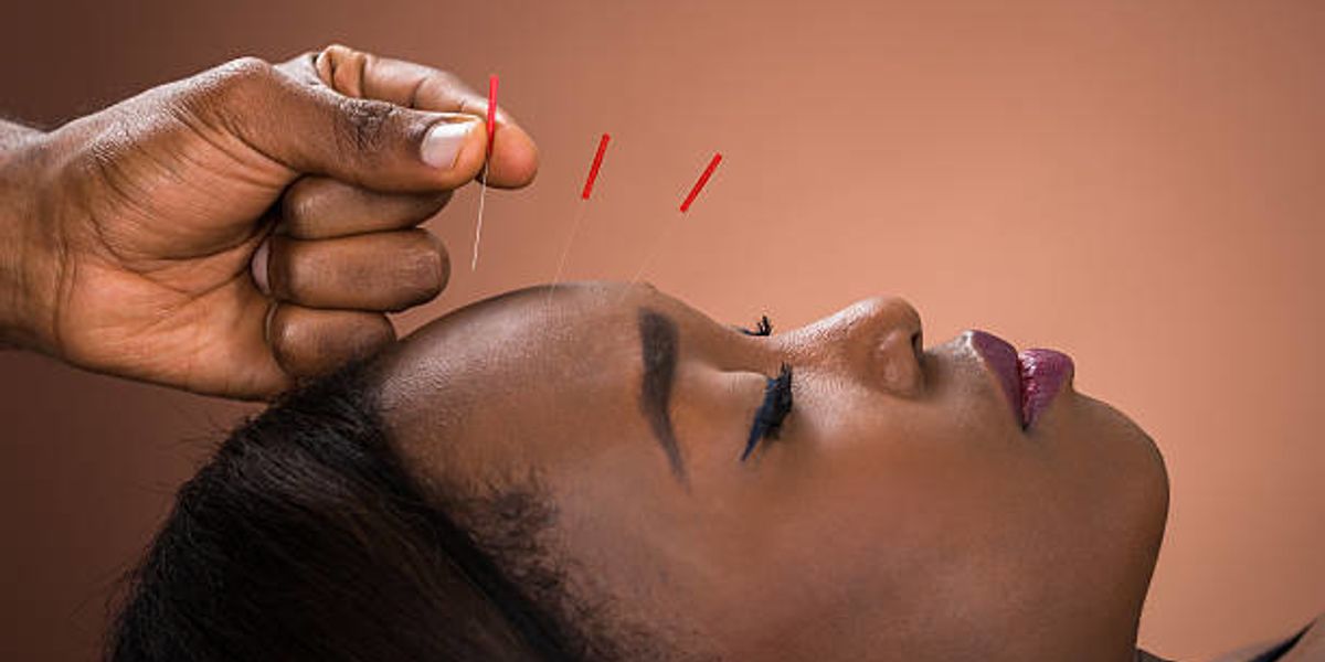 I Tried Acupuncture For The First Time & This Happened