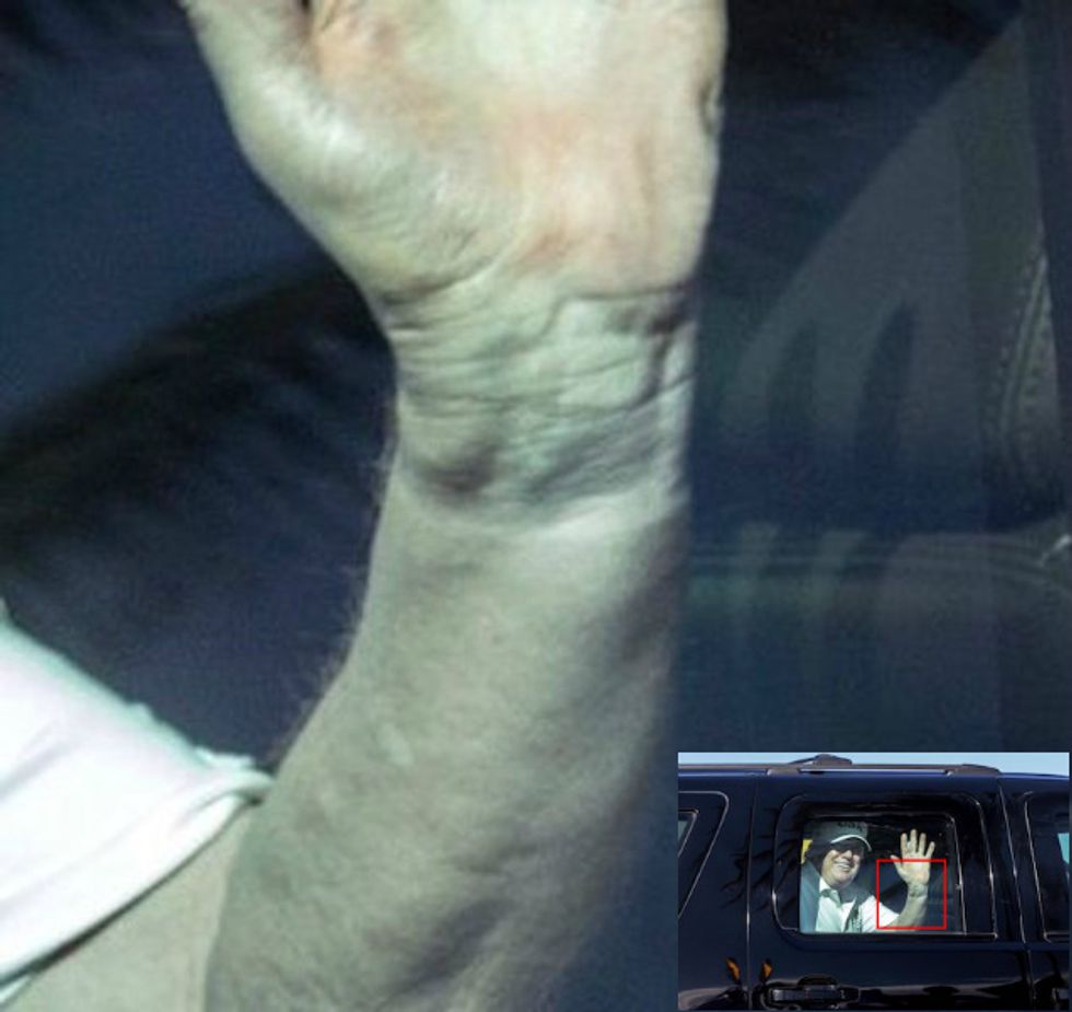 Why Does Trump Always Strangulate His Own Arm In A Torture Watch When He Golfs?