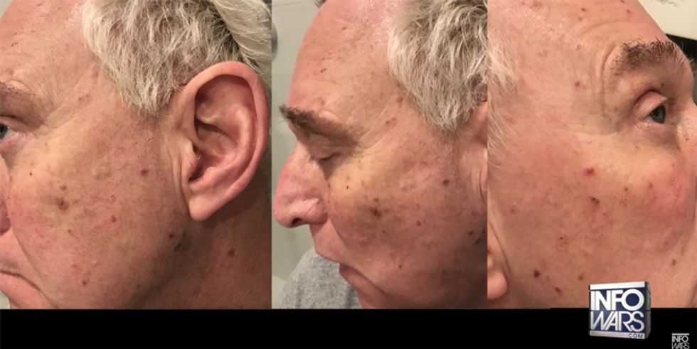 Trump Jerk Roger Stone Was Poisoned To Death By The CIA, But He Got Better