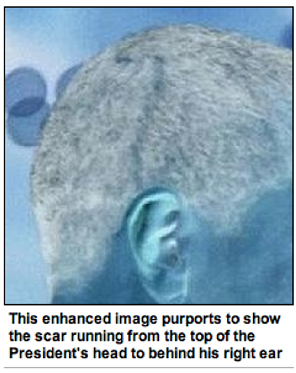 Report: Clumsy Aliens Left Brain Surgery Scars On Obama's Skull
