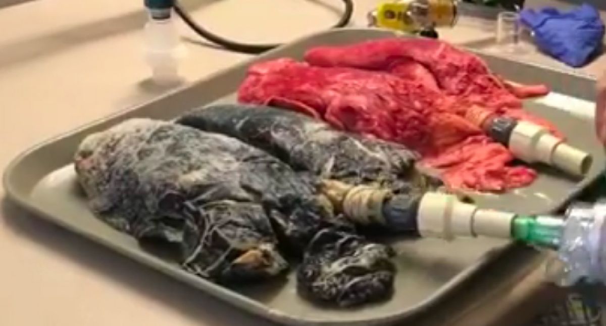 Nurse Shares Video of Two Sets of Lungs That Should Make Anyone With a Nasty Habit Want to Quit
