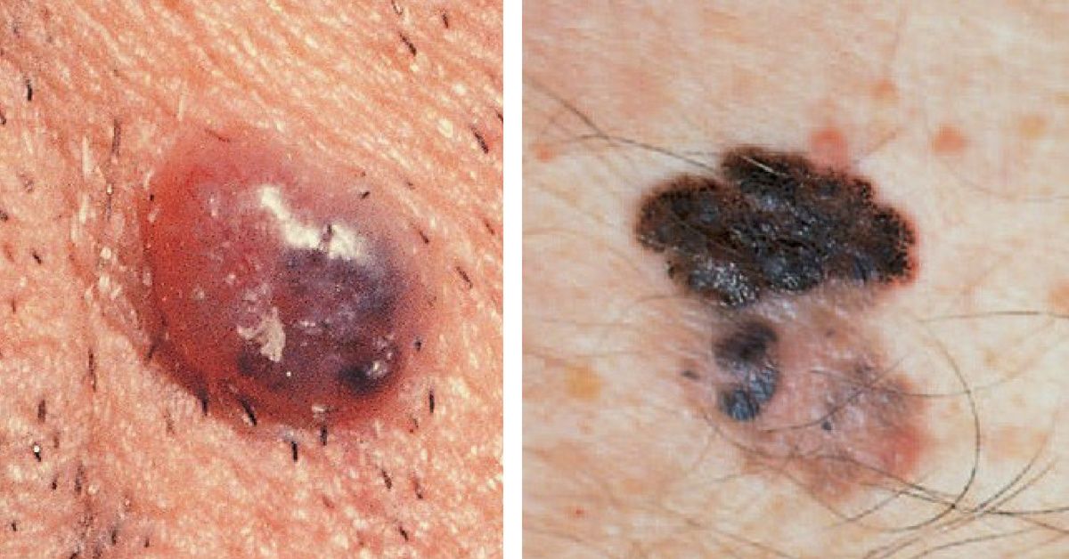 How To Spot The Most Common Forms Of Skin Cancer