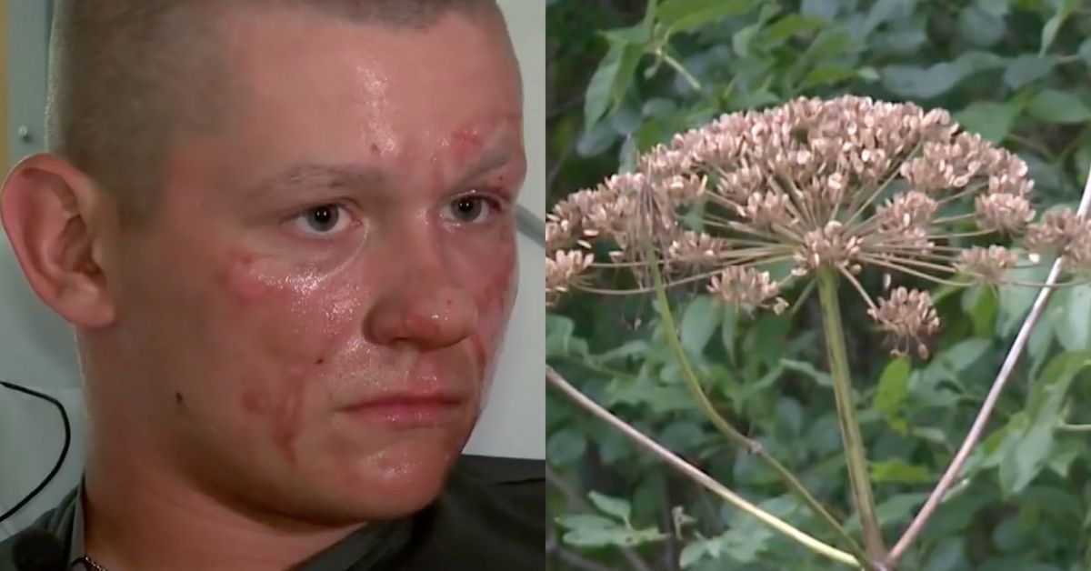 After Run-In With 'Plant From Hell,' Virginia Teen Might Not Be Able To Step Foot In The Sun For 6 Months ðŸ˜®