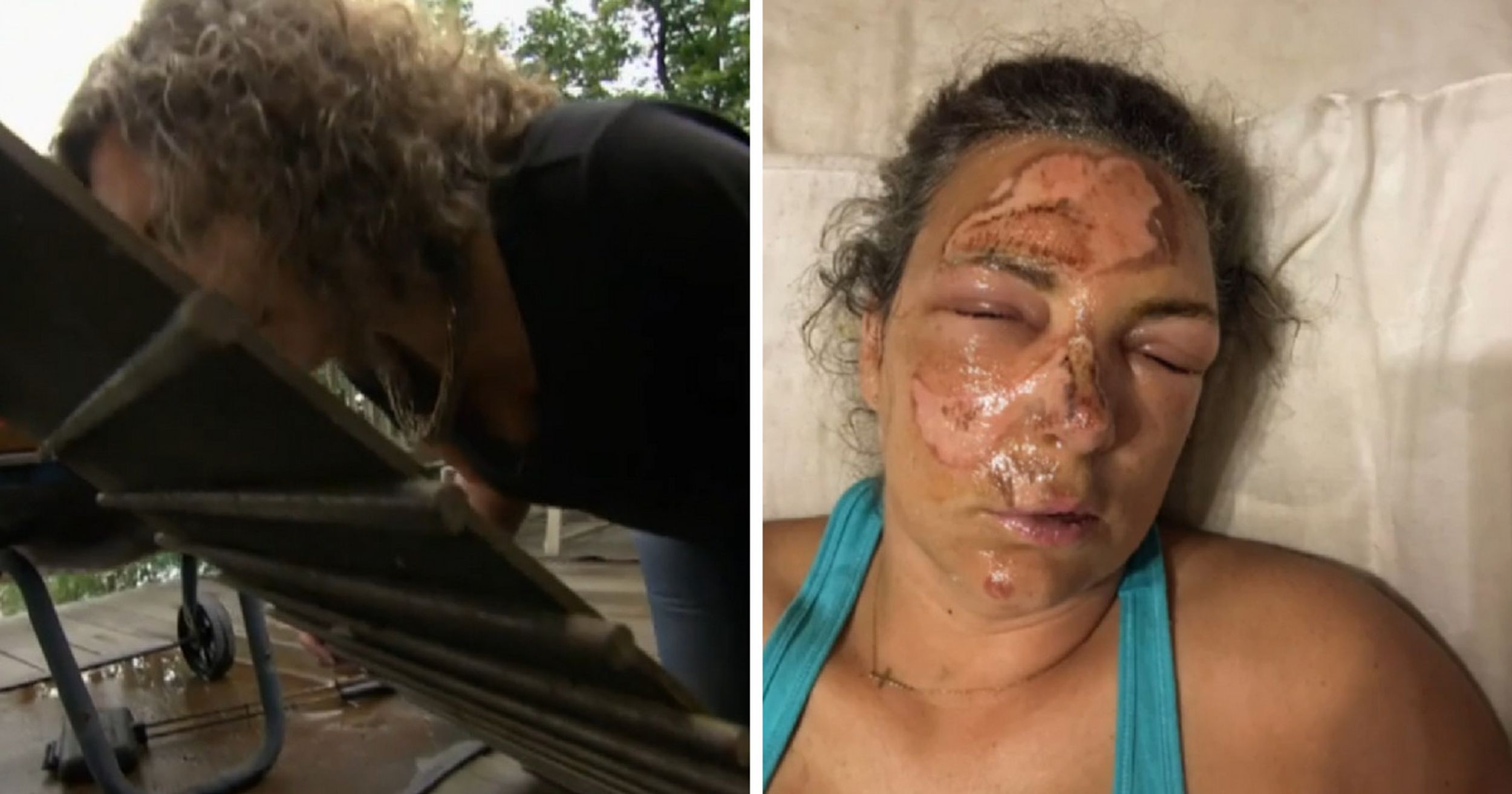 Husband's Quick Thinking Saved Wife's Face After She Fell Onto Hot Grill