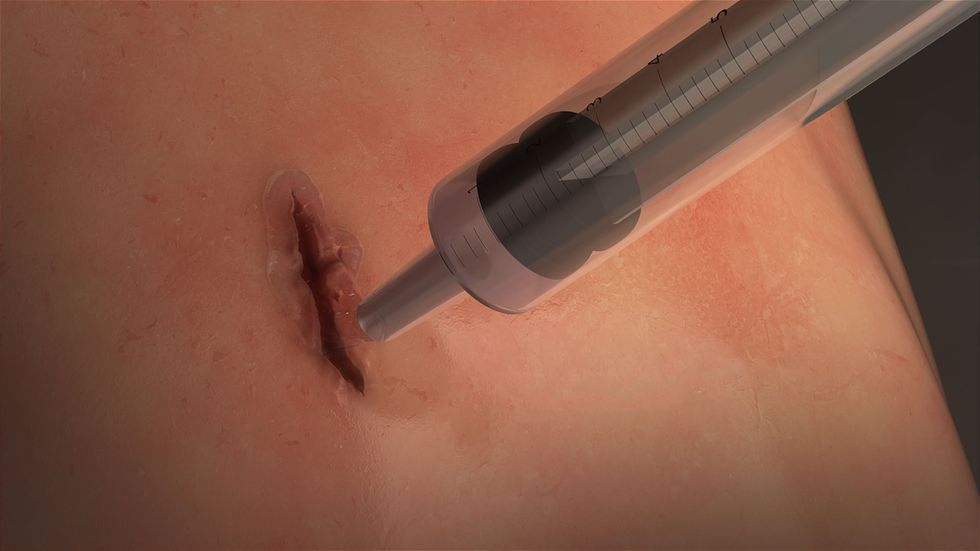MeTro is applied directly into the wound and activated with light. / Credit: University of Sydney