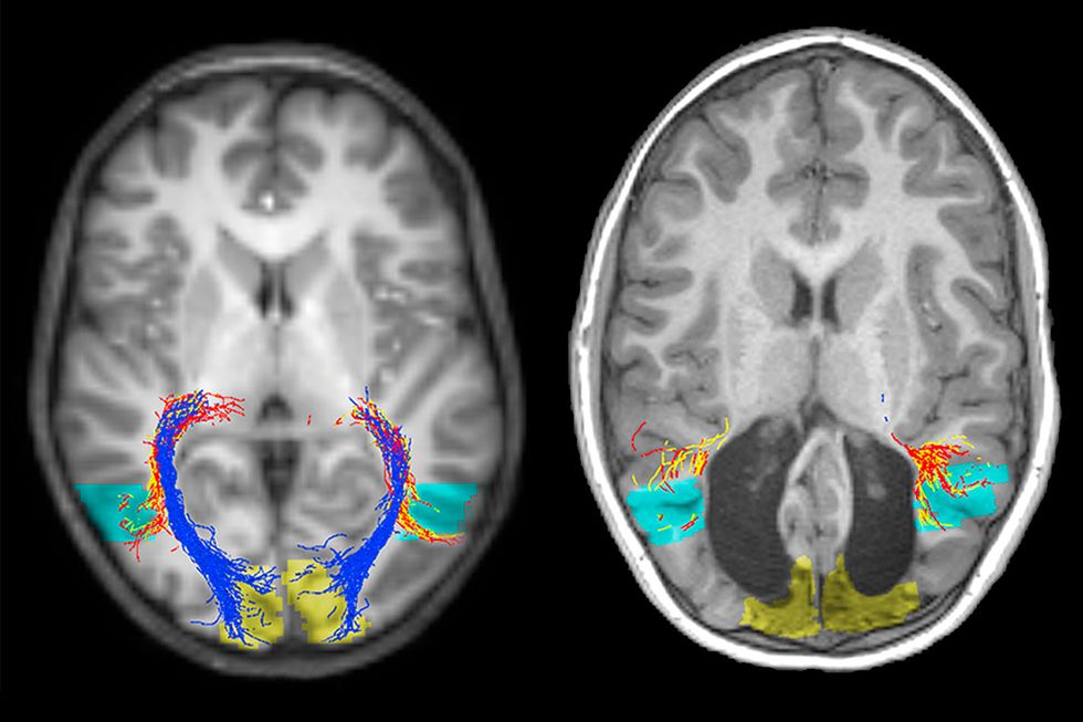 MRI scan of the boy's brain. A normal brain (left) and the boy missing a visual cortex (right).