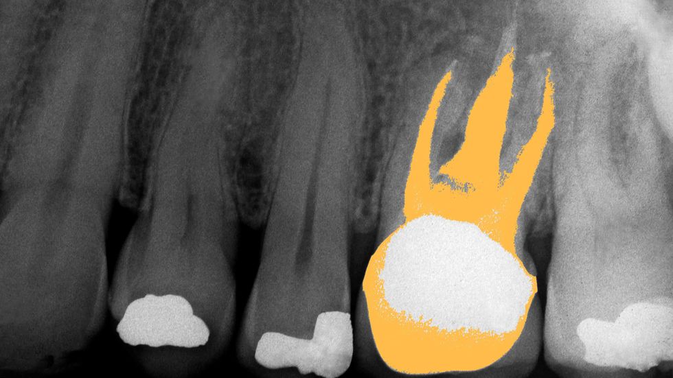 Dental X-Ray showing the upper jaw of a 55-year-old male. One tooth has had a root canal operation performed, and the adjacent teeth show a total of three filled cavities. (Getty)