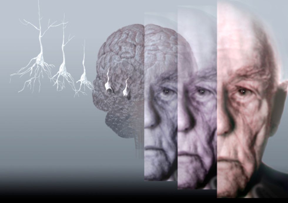 Illustration showing where Alzheimer's is in the brain.