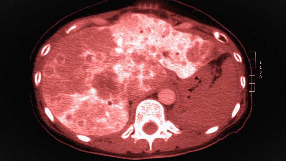 What age should colon cancer screening start at? - Big Think