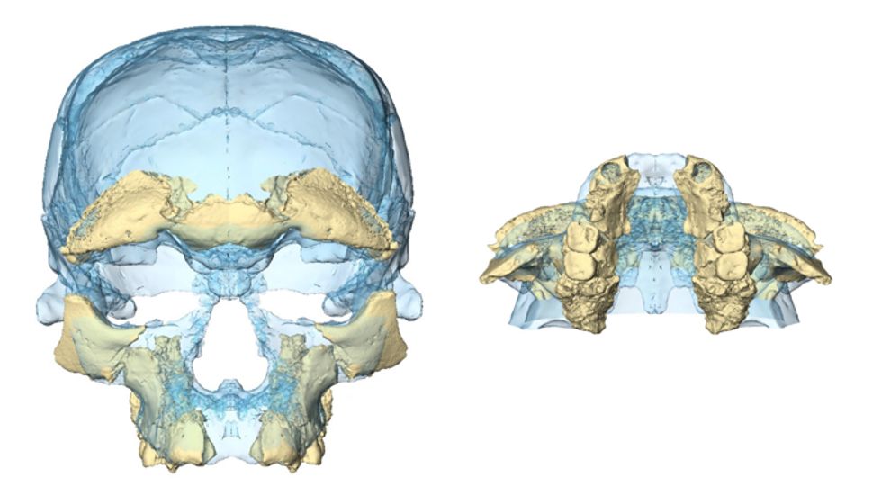 Face and jaw reconstructed