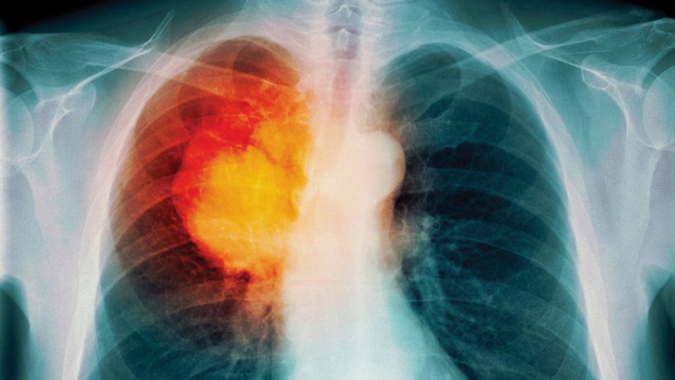 x-ray of lung cancer