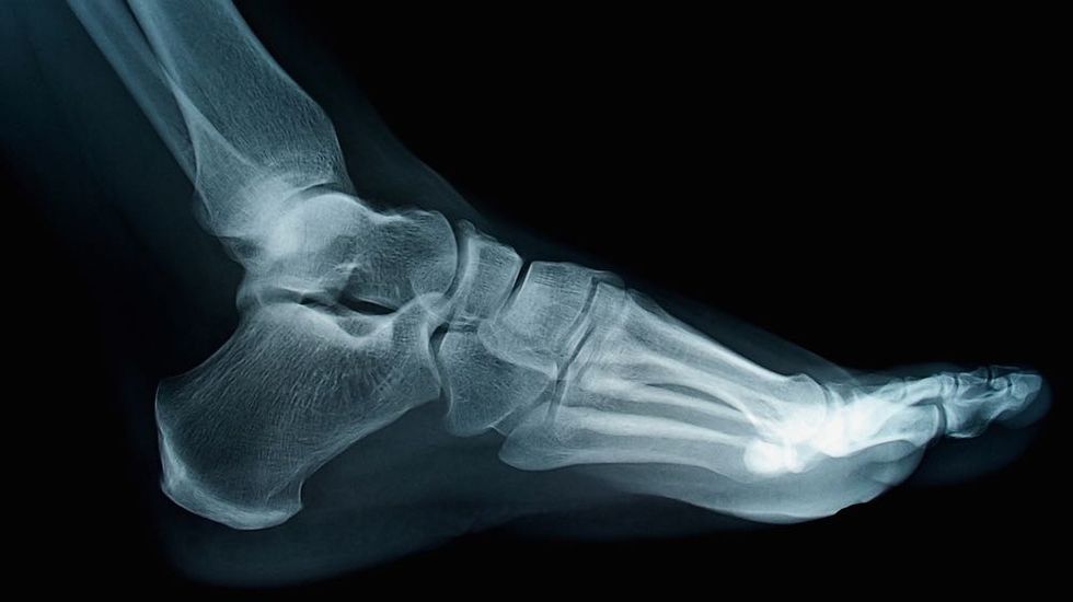 Springy Ankle Device Improves Walking Efficiency 7%