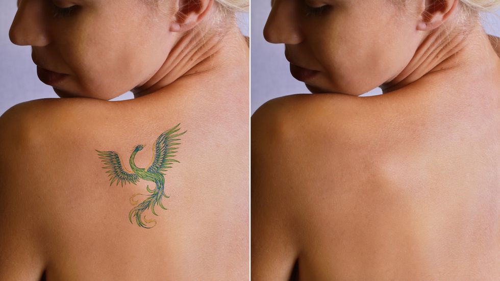 What happens to tattoos when you remove them?
