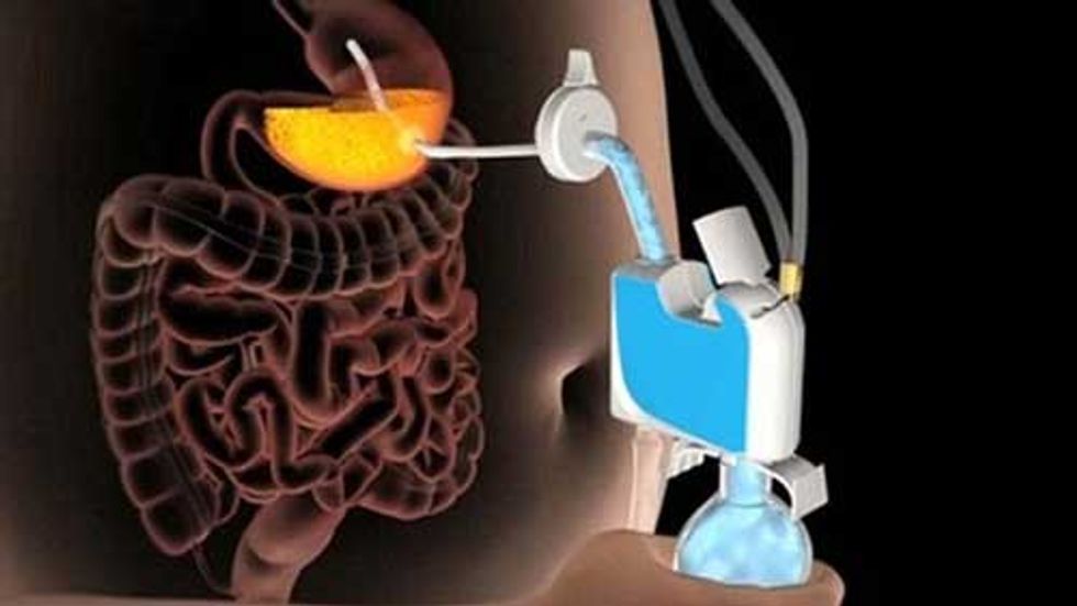 Bizarre FDA-Approved Weight Loss System Encourages Eating Disorders