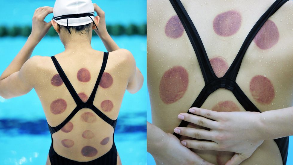 Chinese swimmer Wang Qun is seen with marks after cupping treatment during a training session at the National Aquatics Center a few days before the start of the Beijing 2008 Olympic Games. (MICHAEL KAPPELER/AFP/Getty Images)