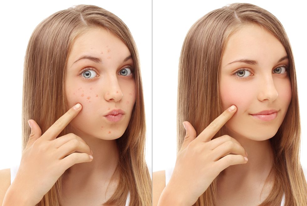 Got Acne? Believe It or Not, There's an App for That.