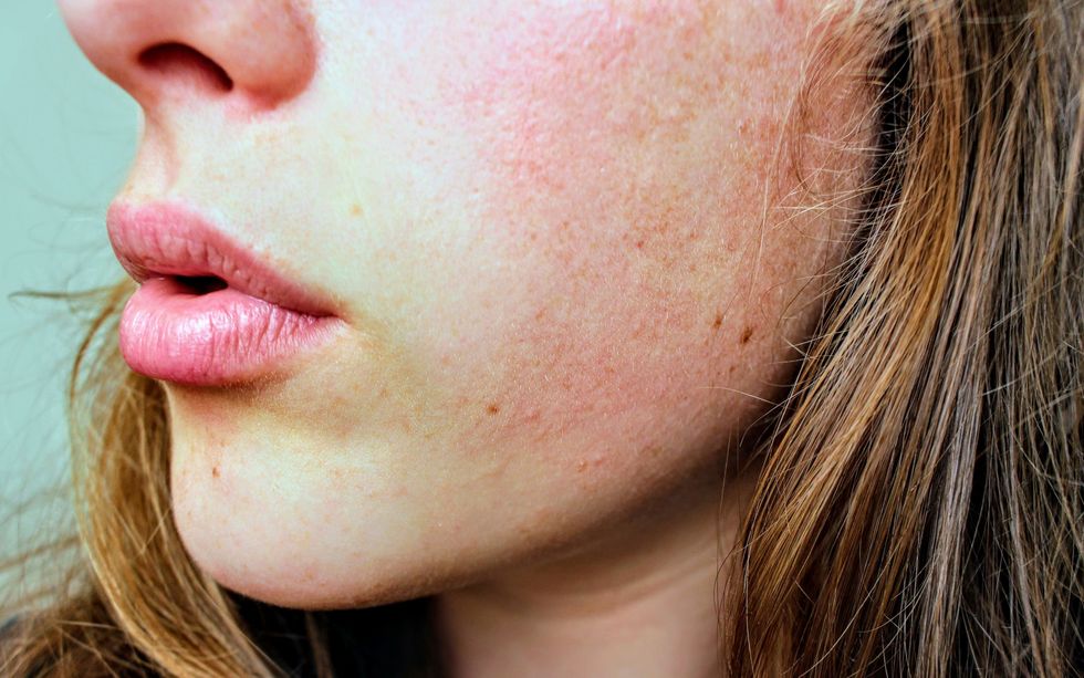 To The Girl In A Losing Battle With Accutane, I'm Living Proof That It Will Get Better