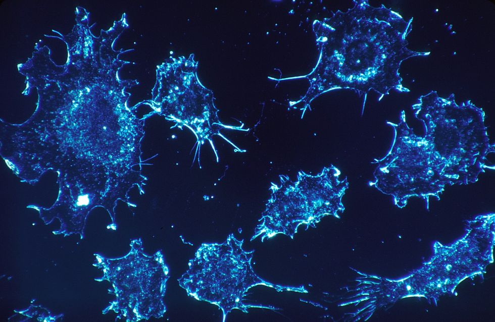 Cancer cells under an electron microscope scan.