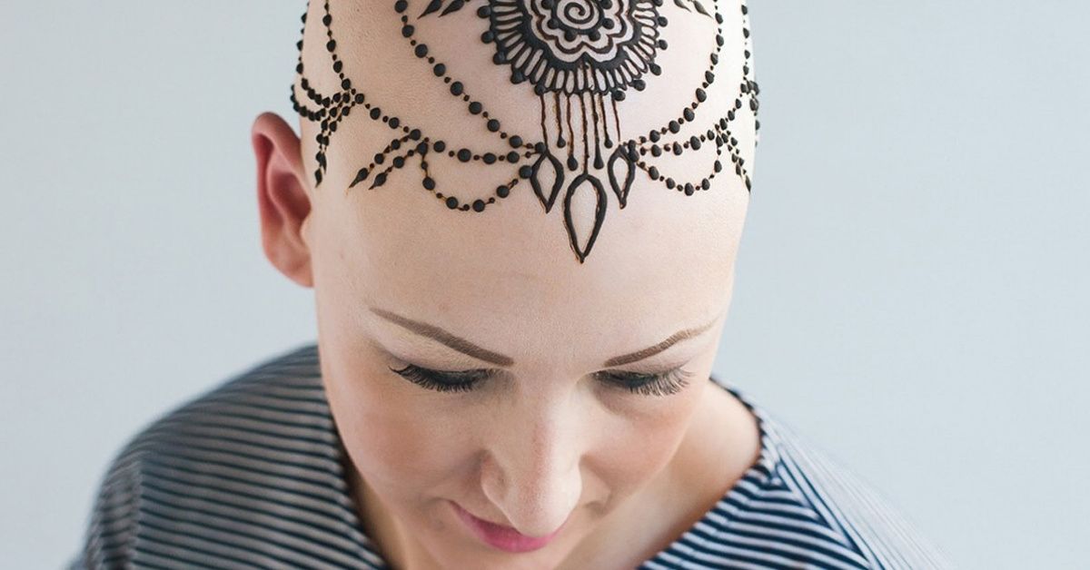Woman Who Previously Slept In Hats To Hide Her Alopecia Is Now Baring All And Embracing It