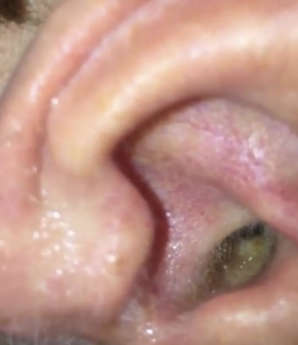 Hit With a Painful Ear Infection, He Takes a Closeup Peek With His