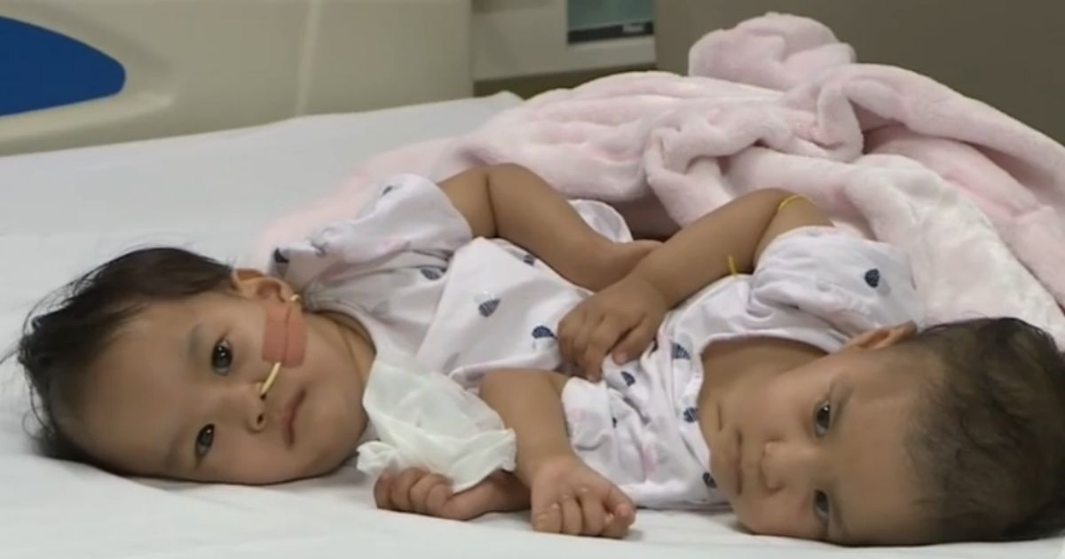Conjoined Bhutanese Twins Undergo Separation Surgery In Melbourne Hospital