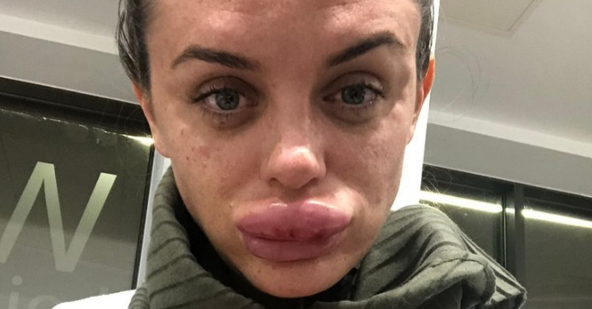 Woman Has An Important Warning For Others After Her Lips Tripled In Size At A 'Botox Party'