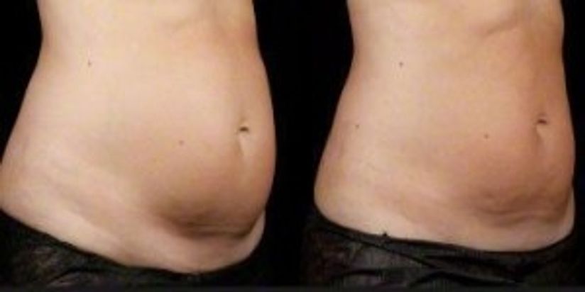 A New Way to Get Rid of Unwanted Fat - HealthyWomen A New Way to Get Rid of Unwanted Fat - HealthyWomen