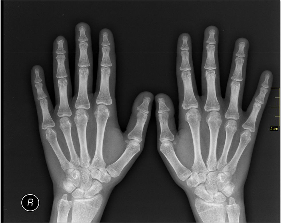 If You’ve Ever Broken A Bone, There’s No Doubt You’ve Been Asked These 13 Questions