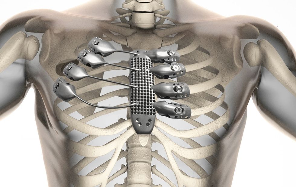 A guy just beat cancer with a freaking 3D-printed titanium chest implant. Take that, cancer.
