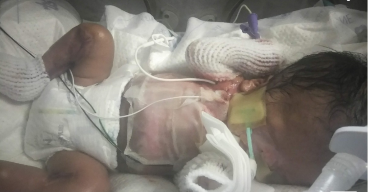 Baby Born Without Skin In San Antonio Due To Rare Condition Is Defying The Odds