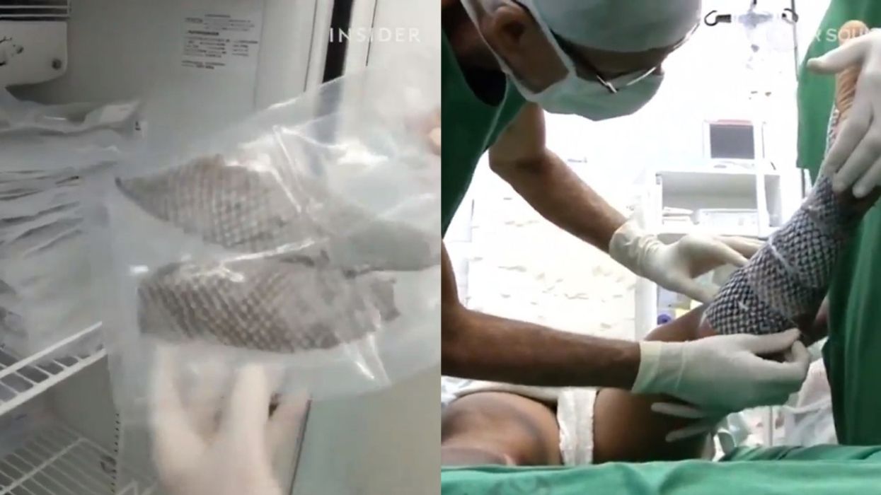 It's Not Just A 'Grey's Anatomy' Thing—Why More Doctors Are Turning To Fish Skin To Treat Burn Patients