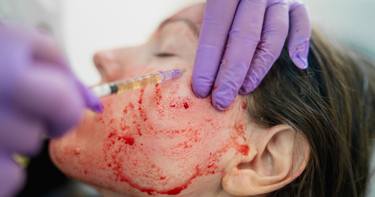 Officials Issue Warning After 'Vampire' Facials From New Mexico Spa Result In HIV Diagnosis For Two Clients