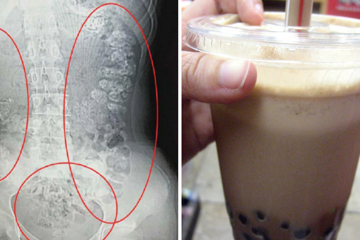 A 14-year-old went to the hospital after 100 bubble tea pearls were caught in her stomach.