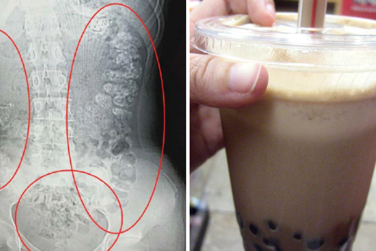 A 14-year-old went to the hospital after 100 bubble tea pearls were caught in her stomach.