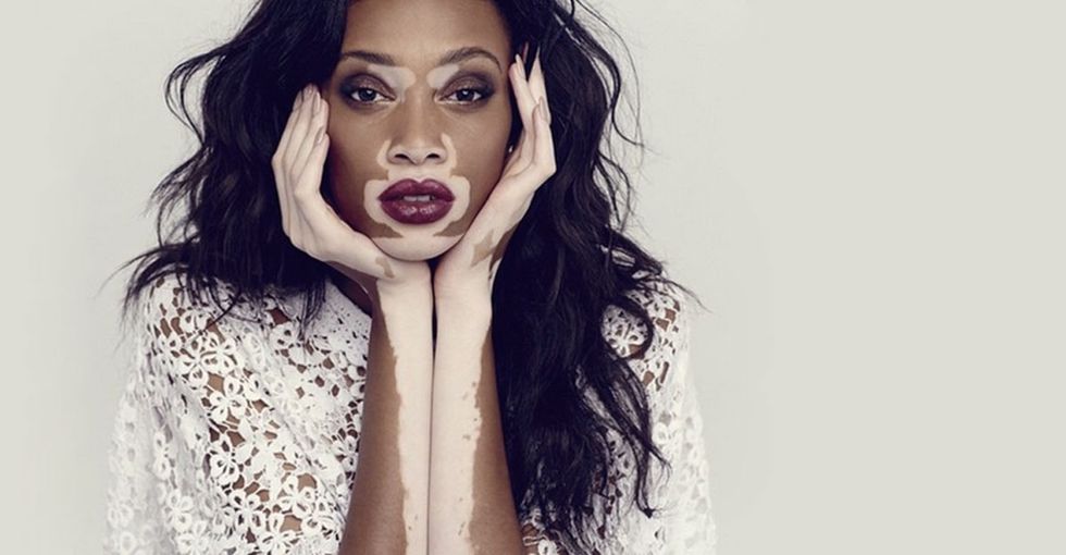 She was teased because of her skin. Now her skin's made her a star.